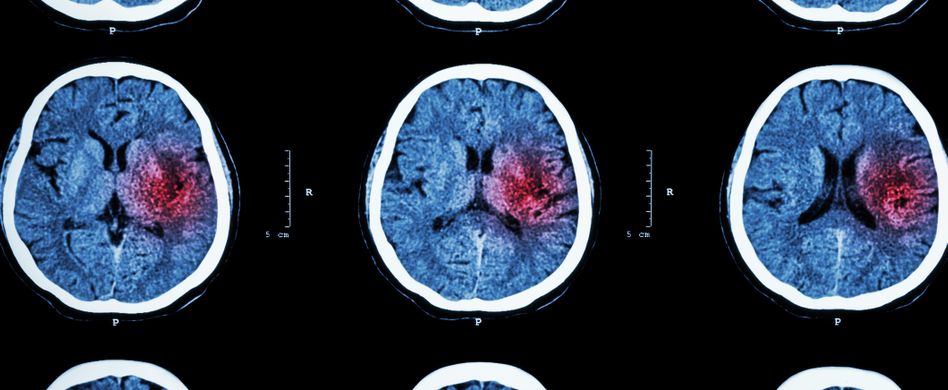 Hämorrhagischer Schlaganfall: Die Blutung im Gehirn