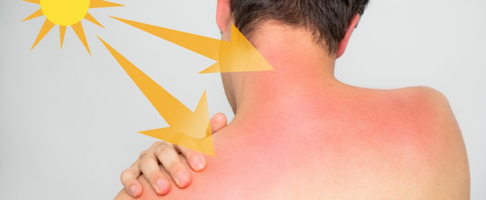 Sonnenbrand: Welcher Hauttyp bin ich und wie lange darf ich in der Sonne bleiben?