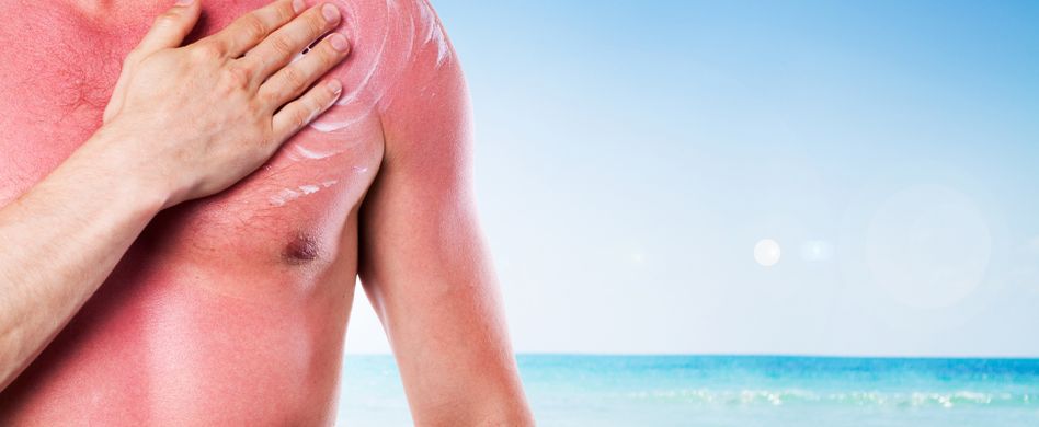 Verbrannte Haut: Wie lange dauert Sonnenbrand?