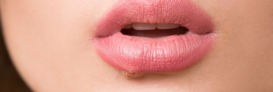 Lippenherpes Fast Jeder Hat Das Herpes Virus