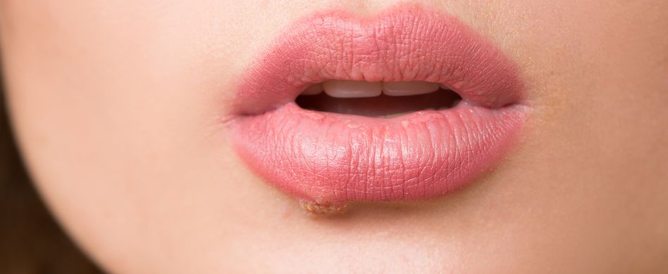 Lippenherpes Fast Jeder Hat Das Herpes Virus