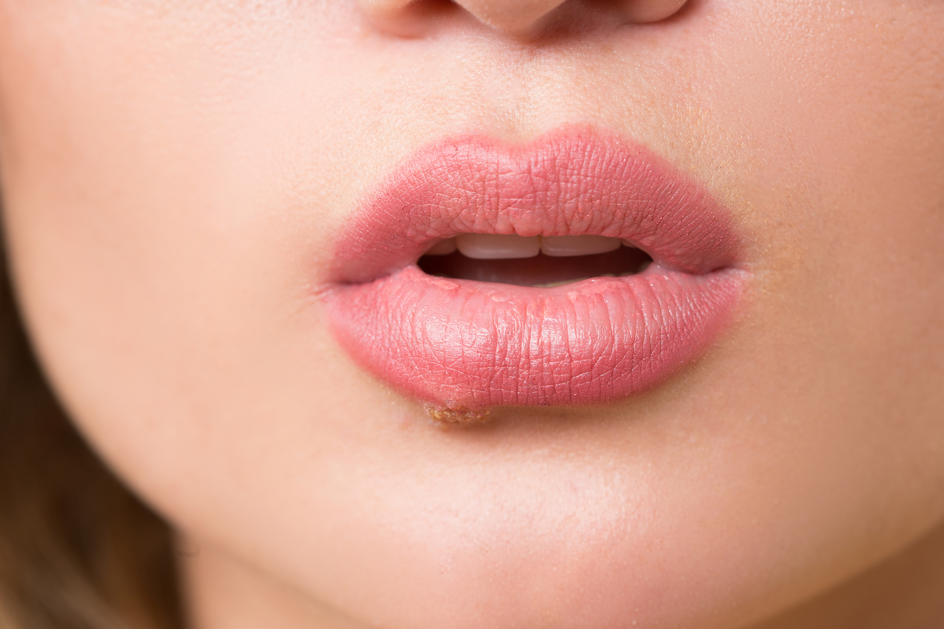 Lippenherpes Fast Jeder Hat Das Herpes Virus