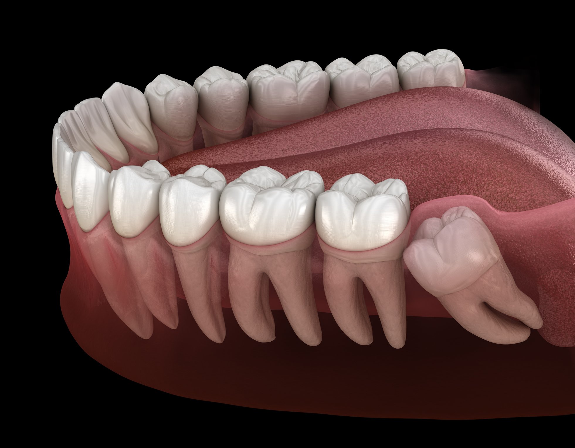 Zahnfleisch weisheitszahn drückt gegen Weisheitszähne: Funktion,