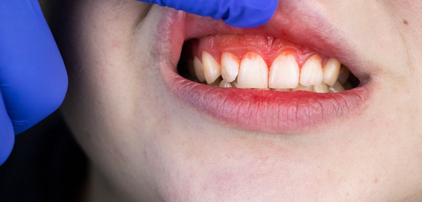 Zahnfleischentzündung → Hier alles erfahren, was Sie dazu wissen müssen