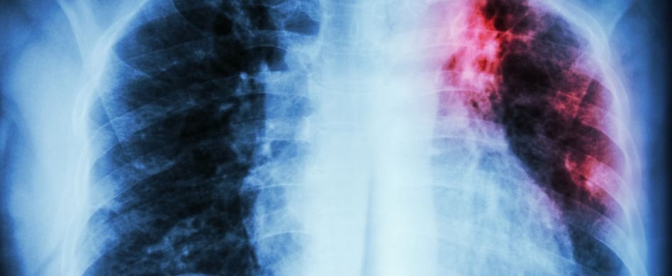 Lungenfellentzündung (Pleuritis): Ursachen, Symptome und Behandlung