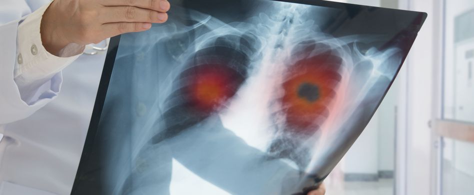 arzt hält röntgenbild mit lunge welche einen fleck hat